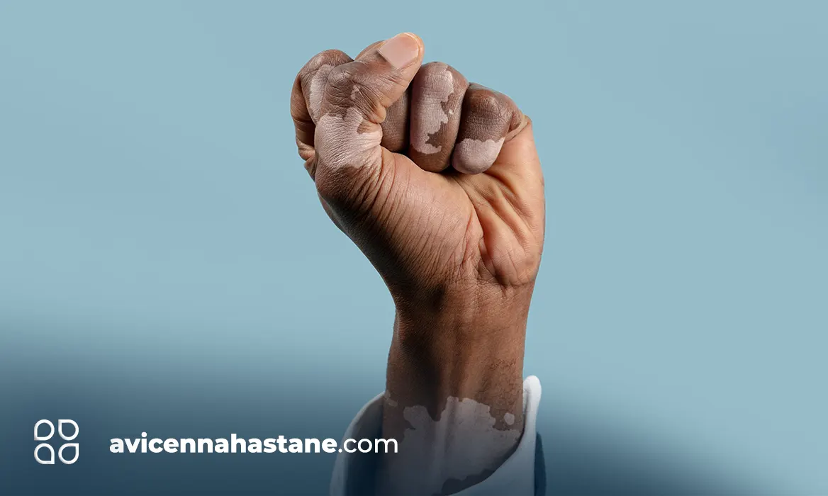 vilitigo-nedir-avicenna