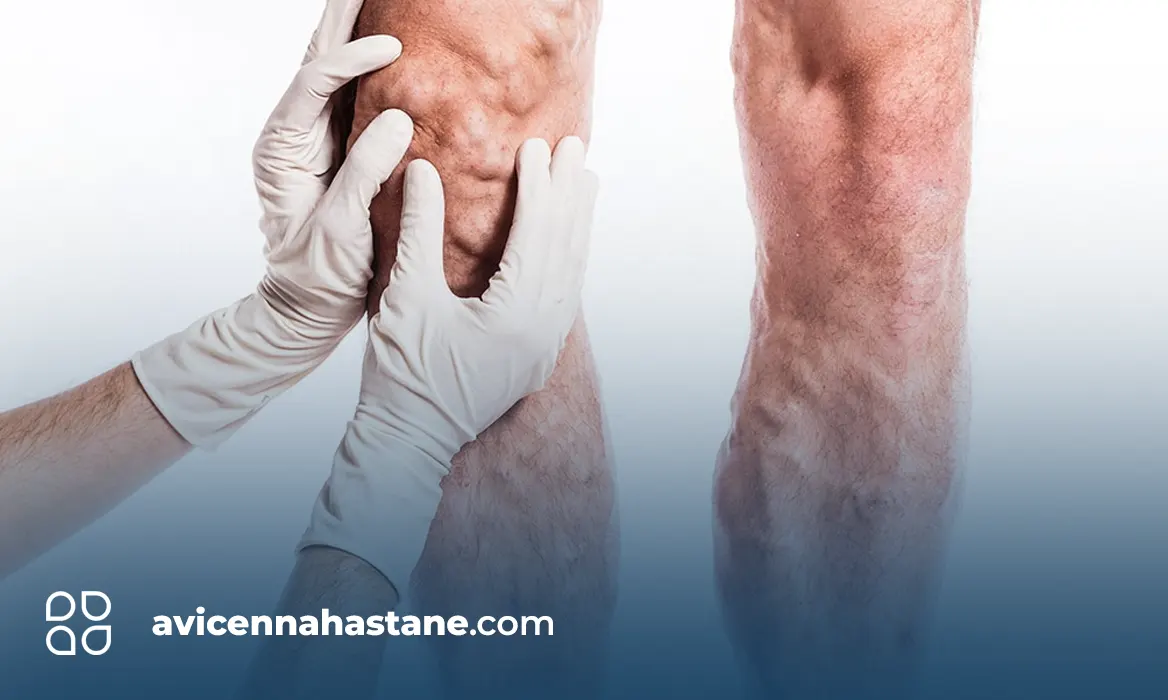 Hangi-Varis-Tehlikelidir-avicenna-hastanesi