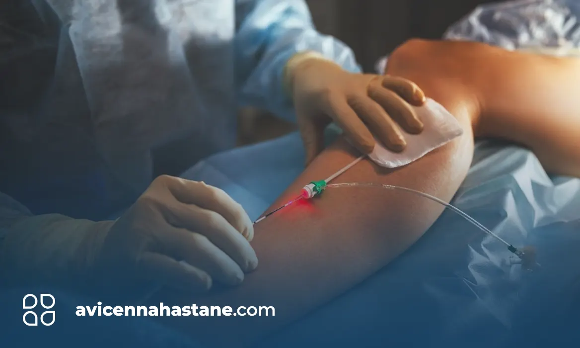 lazerle-varis-tedavisi nedir